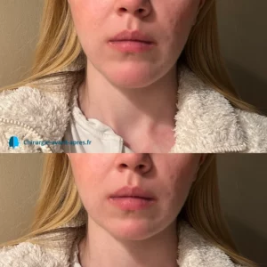 genioplasty chin reduction seen from the front