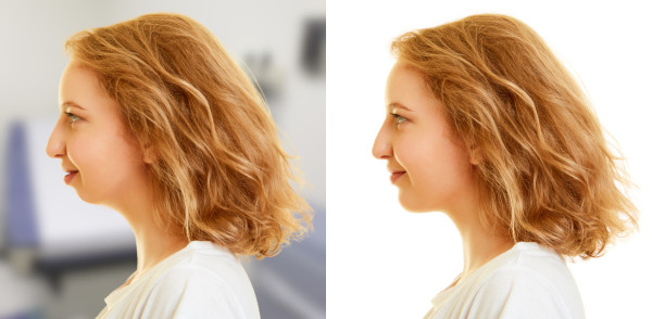 genioplasty chin surgery chin-wing