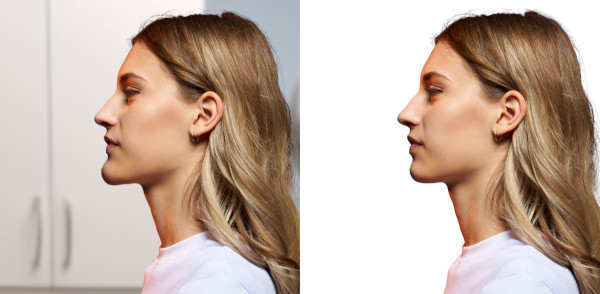 genioplasty surgery chin reduction before after 600r
