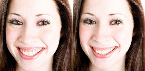 gummy smile surgery before after 600