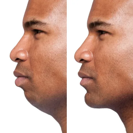 receding chin before after