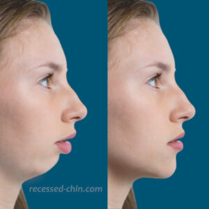 receding chin picture