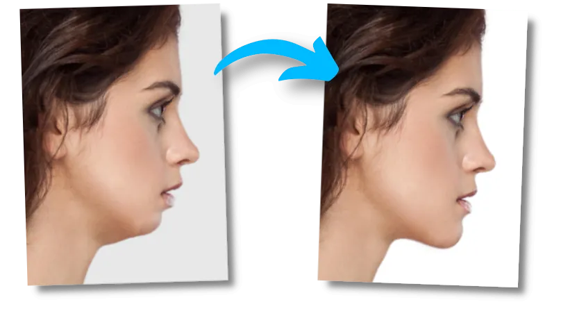 recessed chin