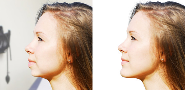 retrognathic surgery before and after 600r