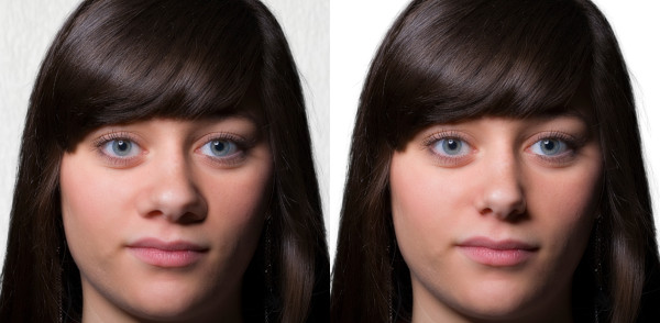 rhinoplasty nostril reduction