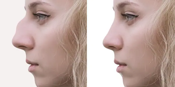 rhinoplasty surgery big nose